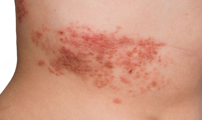 HELVETESILD BEHANDLING SOM FUNGERER